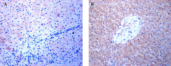 Immunohistochemical staining was performed using a specific antibody against human the TLR3 protein. TLR3 stains in the livers of an ACH patient and HCC patient are shown. A, No TLR3 stains were found in the NPCs, hepatocytes, or necroinflammatory zone in the liver of the ACH patient at × 400 magnification. B, TLR3 stains with brown granules primarily appeared in the NPCs and hepatocytes, with some staining exhibited in the cells of the portal area, in the HCC subject. The NPCs with TLR3 stains surrounded the hepatocytes at × 400 magnification.
