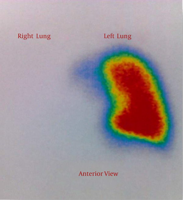 Unilateral Absence of Right-Lung Perfusion