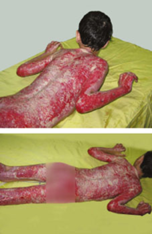 Photograph Showing Wound Appearance Was Better Than Last Days. Novel painless dressing with ENTONOX mask is shown in this picture.