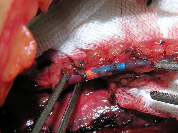 Catheter in the Left Internal Mammary Vein