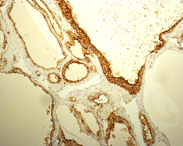(Immunohistochemical stain, HBME1, original magnification 200×).