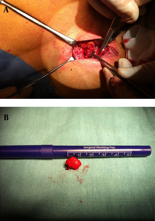 A, Intraoperative dissection of the PTH carcinoma; B, the specimen following removal.