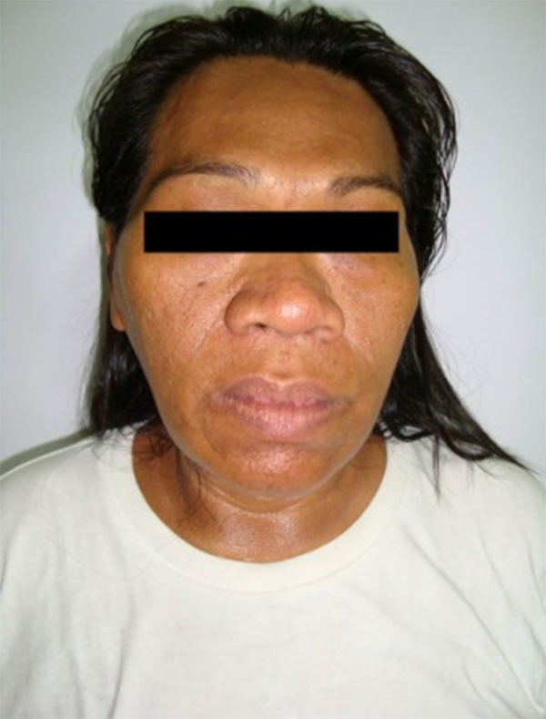 Coarsened Facial Features of a 46-Year Old Female Diagnosed With GH-Secreting Pituitary Adenoma