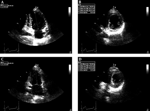 The measurements of left ventricular mass (area-length) at end diastole and peak systole using biplane two-dimensional echocardiographic methods. A, LVLd apical, left ventricular length at end diastole, apical; B, LVAd SAX EPI, left ventricular epicardial short axis area at the level of the papillary muscle tips at end diastole; B, LVAd SAX PM, left ventricular endocardial short axis area at papillary muscle level at end diastole; C, LVLs apical, left ventricular length at peak systole, apical; D, LVAs SAX EPI, left ventricular epicardial short axis area at the level of the papillary muscle tips at peak systole; D, LVAs SAX PM, left ventricular endocardial short axis area at papillary muscle level at peak systole