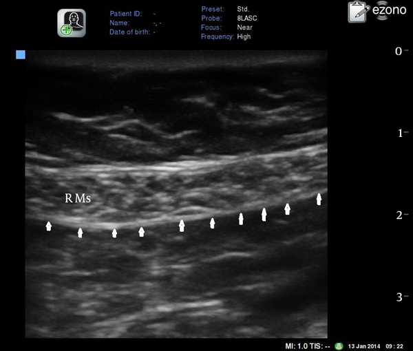 R Ms: rectus abdominis muscle. Arrows: posterior rectus sheath.