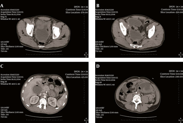 Sections of Contrast-Enhanced Abdominal CT of the Patient