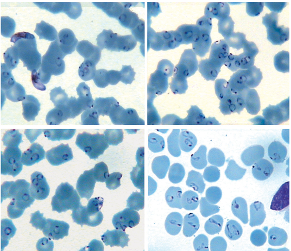 Among RBCs, 75 to 85% contained one to five parasites per cell (Giemsa stain, X1000)
