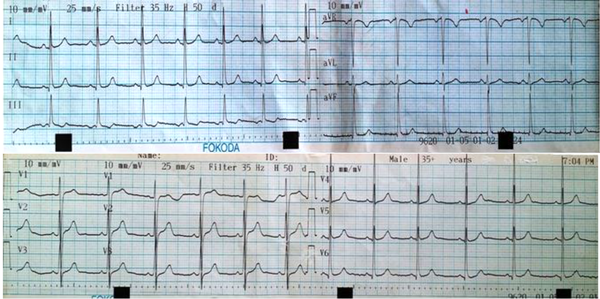 An Electrocardiography Before Using Oxazepam in the Patient