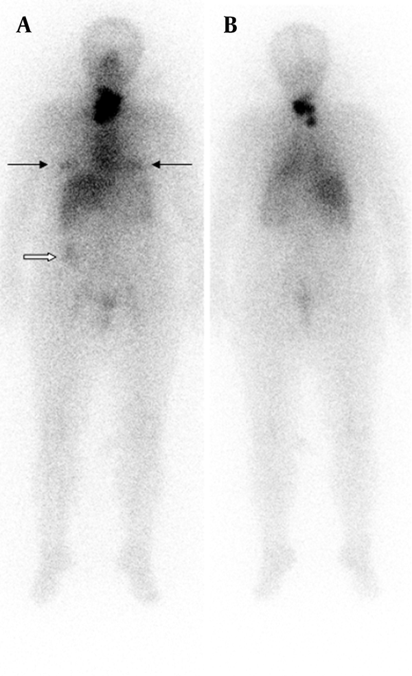 Teaching point: Physiological bilateral breast and colon activity may be seen in radioiodine scan.