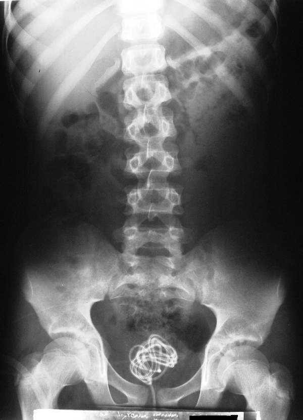 Plain Abdominal X-ray of Patient With a Very Long Foreign Body in the Bladder and Urethra
