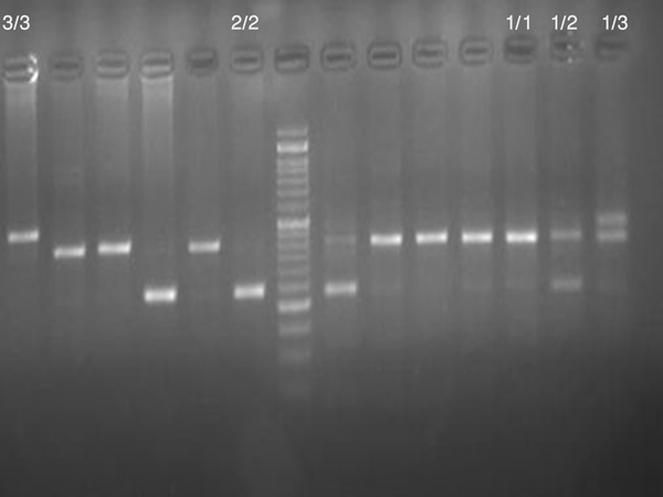1. Electrophoretic Pattern of PCR Amplified Products of IL-1 Ra Gene VNTR Polymorphism: M, 50 bp DNA Marker