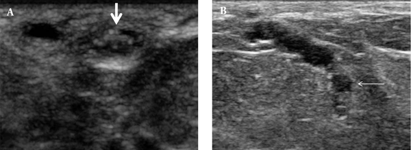 Sonography of the left breast shows two cystic lesions, one in the subcutaneous plane (solid arrow) (A) and the other in the fatty breast parenchyma (line arrow) (B), both showing multiple curvilinear echoes with a dilated interconnecting tubular channel.