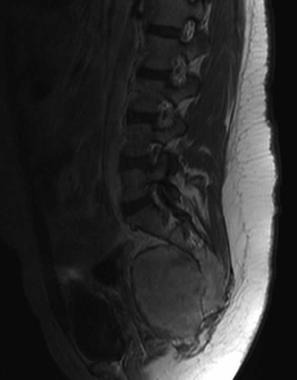 Contrast-enhanced sagittal MR T1-weighted imaging shows marked enhancement of the mass.