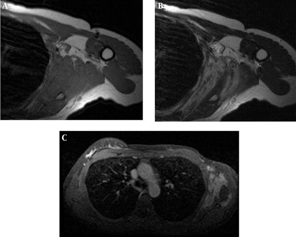 A 38-year-old woman with a history of left sided breast cancer treated with modified radical mastectomy underwent MRI of the chest wall. A, MRI T1 and B MRI T2; on non-enhanced left shoulder MRI, huge infiltrative soft tissue mass was isointense to muscle on axial T1-weighted images (A) and heterogeneous hyperintense with several hyposignal intensity foci on axial T2-weighted images (B). The mass had continuity with teres minor and major, latissimus dorsi, serratus anterior, subscapularis, focally infraspinatus and chest wall muscles. C, T1 Contrast enhanced MRI: after contrast administration, the mass showed an intense heterogeneous enhancement.