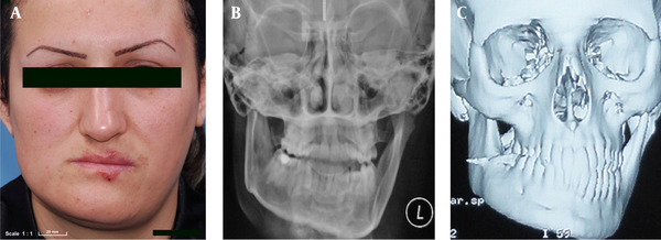 a: A 30-year-old female complaining of a deviated mandible and facial asymmetry, pre-op images; b: Elongation of the condylar neck, increased size and length of the condyle, downward projection of the angle and body of the left mandible; c: CT scan revealed deformity of the left side of the mandible.