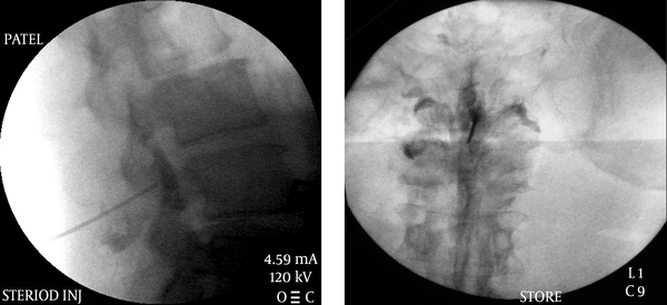 Lumbar Interlaminar Epidural Injection AP and Lateral Views