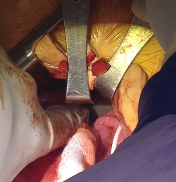 Intraoperative Image Demonstrating Intraperioneal Migration of a Subfascially Placed Baclofen Pump as Evidenced by Pump Being Surrounded by Bowel
