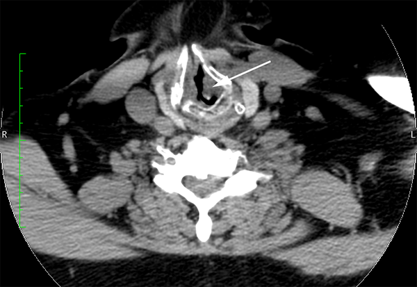 Enlarged Axial Computed Tomographic Scan Demonstrating Subglottic Stenosis (Arrow) and Narrowed Airway Lumen