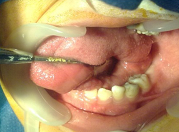A Sample of Intraoral View (Mandibular Left Side) Following Dental Treatment Under G.A