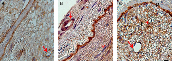The locations which positive expressed were brown. Control: (A), Diabetic: (B) and Diabetic ALA treated: (C) group. Perineurium (P), Endoneurium (E), Blood vessels (arrows), Fibroblasts (arrow heads), Scale bar =10 μm.