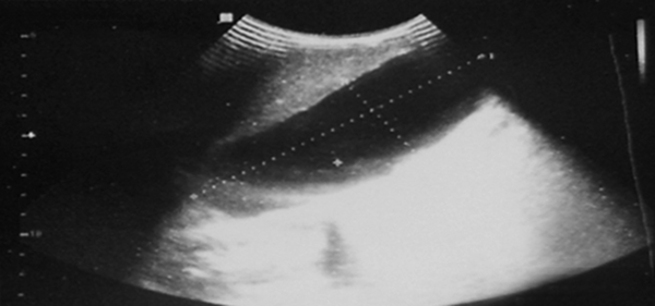 Abdominal ultrasonography showed normal size and echogenicity of the liver, with significantly distended gallbladder (span 130 × 50 mm); fundus of gallbladder was near iliac crest. The thickness of gallbladder wall was normal and no stone was detected. The hydrops of gallbladder was confirmed.