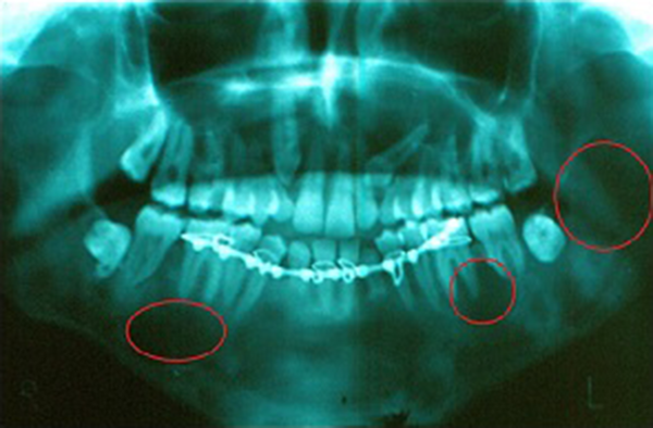 Multiple Lesions in the Mandible, and Impacted Teeth in Panoramic X-Ray