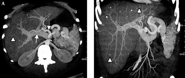 Intrahepatic arterioportal shunts. A and B, Reconstructed images of maximal intensity projection in the parasagittal and coronal plane show early opacification of the portal veins (white arrow) and arteries (dashed arrow). The presence of multiple telangiectasias (white arrowheads) is evident. (Note: These tiny dense highlighted foci in both images, near the described telangiectasias and even outside of the hepatic field, are calcifications.)