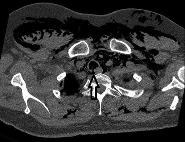 Chest CT Showing Linear Tracheal Rupture in Posterior Wall (Arrow), Pneumomediastinum, and Subcutaneous Emphysema