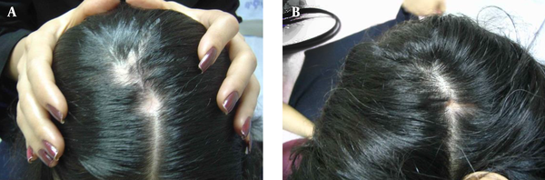 Discoid Lesions on the Patient’s Head A, Before and B, After Application of Low-Level Laser Irradiation; Note the Size of the Lesions Before and After Low-Level Laser Therapy