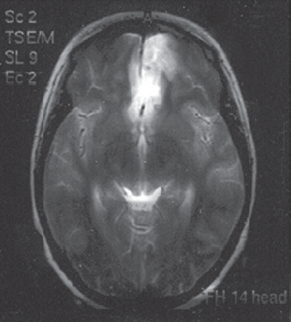Axial T1, T2, PD, MRI. Diffuse Subarachnoid Hemorrhage; Ischemic Changes in the ACA Territory