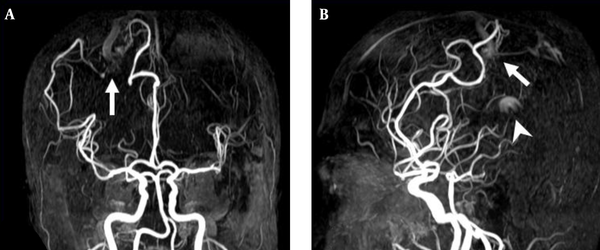 3D TOF MRA of the AVM shown in Figure 4. A, Coronal; B, Sagittal views also reveal a focal hyperintense nidus (arrow) in the right parietal region supplied by branches deriving from right anterior and middle cerebral arteries. However, the venous drainage cannot be confirmed due to lack of venous phase information. In addition, a high signal intensity (arrow head) resulting from flow artifacts of the great cerebral vein is visualized.