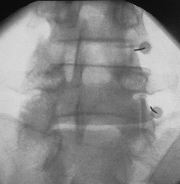 Anterior-Posterior Fluoroscopic View Showing the PRF Cannula Directed Towards the Tip of the Superior Articular Process of Facet joint