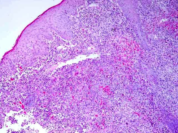 Infiltration of Inflammatory Cells and Tuberculoid Granuloma in Dermis