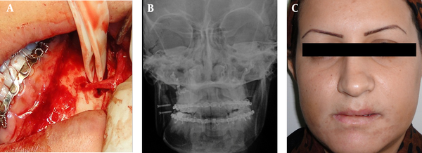 a: The osteotomy was done under direct visualization of the nerve b: By occupying internal rigid fixation with miniplates and screws, the correction of the previous asymmetry was achieved after surgery; c: patient’s face two years after the surgery.