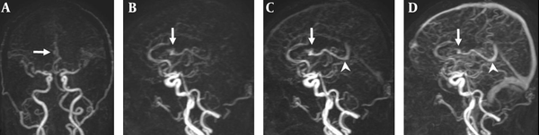 A 47-year-old man with a small AVM in the right lateral ventricle. A, Coronal TR-MRA shows the right lateral ventricle AVM with a nidus (arrow) supplied by a branch of the right anterior cerebral artery; B, Sagittal early; C, Late arterial; D, Venous phase TR-MRA images show the nidus (arrow) in the right lateral ventricle. Deep venous drainage occurs via an internal cerebral vein (arrow head) in the straight sinus.