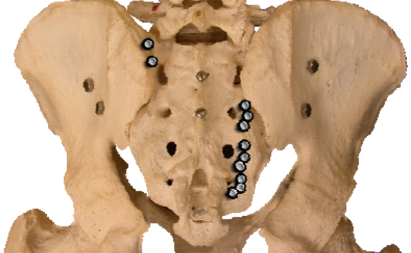 The Image Showing the Spherical Lesions Created by Cooled RF Lesioning and the Targeted Areas Around the Posterior Sacral Foramina as Well as the L5 Lesion Targets