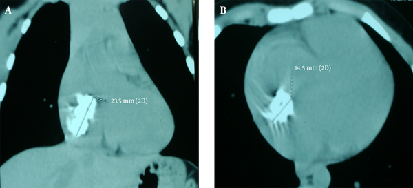 Cardiac Computed Tomography Scan Showing a Right Atrial Mass. A, Sagittal Section. B, Axial Section.