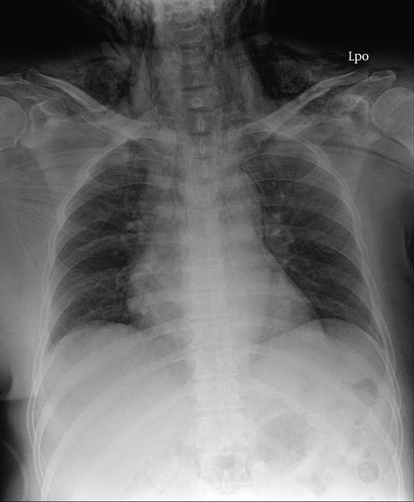 Chest X-ray PA View Showing Pneumomediastinum and Subcutaneous Emphysema in the Neck and Chest Wall
