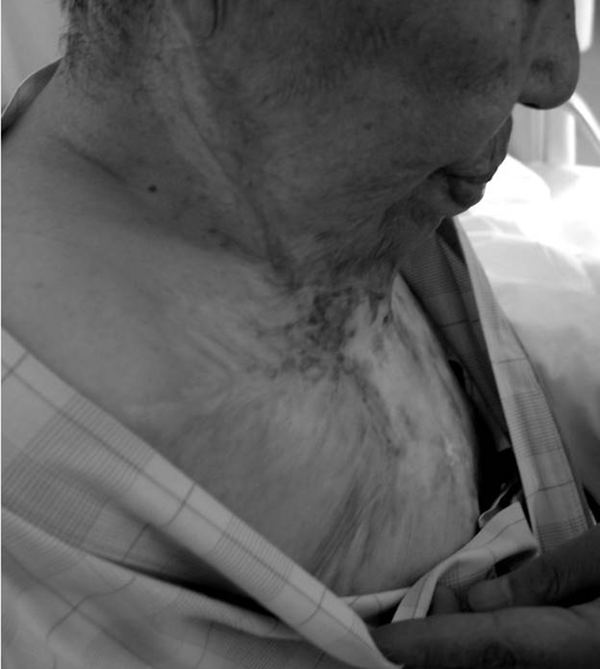Patient wIth Cervico-Thoracic Burns Showing Contractures of the Neck and Chest
