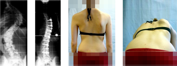 These images show a combined curve, which was surgically corrected. However, the rib hump reappeared later on and the patient was not happy with the surgical outcome (39)