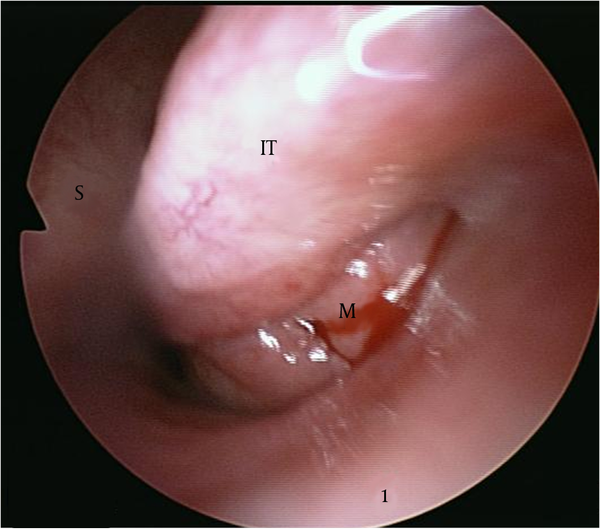 A 55-year-old man with a history of recurrent nasal bleeding and obstruction. After shrinkage of the inferior turbinate mucosa, we observed a lobulated pinkish mass in the inferior meatus that caused medial displacement of the inferior turbinate. (M: mass, S: septum, IT: inferior turbinate)