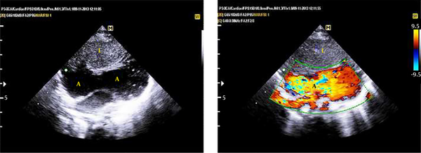 Subcostal two-dimensional echocardiogram on the left shows the huge CGRAA, with an oblique lie from right and anterior to left and posterior of the heart. The right image shows the appearance of blood flow within the aneurysm by lowering the Nyquist frequency to about 10 cycles/second.