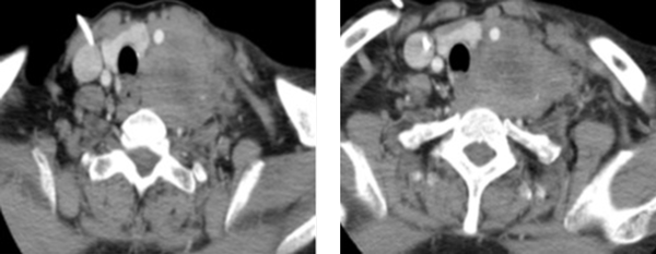 Computerized Tomography Scans of the Patient with Gastric Adenocarcinoma Metastasizing to Left Supraclavicular Fossa