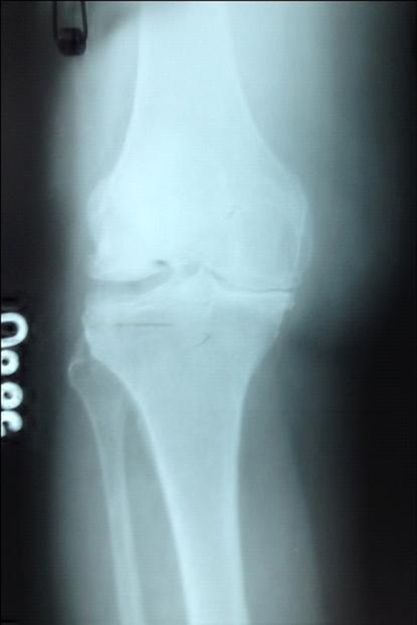 Knee Radiography Before Prolotherapy