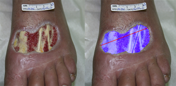 Patient 2, Five Weeks after Treatment with Trichloroacetic Acid