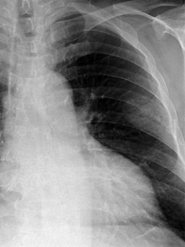 A 63-year-old man presenting with an incidentally detected rib mass on a plain chest radiograph diagnosed as hemangioma. Plain radiograph of the chest illustrates a moderately defined mass in the left upper hemithorax arising from the sixth rib.