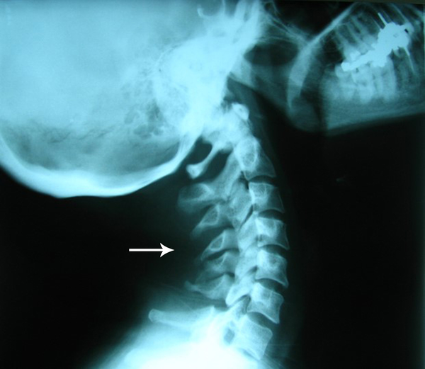 A 36-year-old woman with neck pain and semi-lateral radicular pain in the right hand. A lateral plain x-ray of the neck reveals an ill-defined hypoattenuated area adjacent to the deep soft tissue of the posterior aspect of the C3 and C4 vertebrae, just posterior to the related spinous process and some irregularity or possible erosion in the spinous process of fifth cervical vertebra.