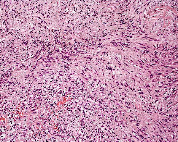 The cells tend to form palisade patterns where the nuclei are seen on the same level in the palisade. This microscopic feature is significant for these tumours (haematoxylin and eosin [H &amp; E], original magnification x40).