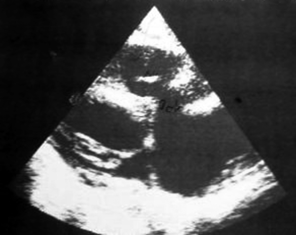 Echocardiogram Showing Large Left Atrium and Left Ventricle, Large Membranous Ventricular Septal Defect and a 5 mm Vegetation at the Right Ventricle