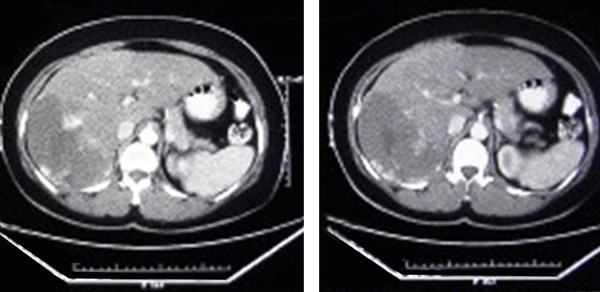 CT Scan Shows a Liver Hemangioma in a 52 Year-Old Female With Abdominal Pain